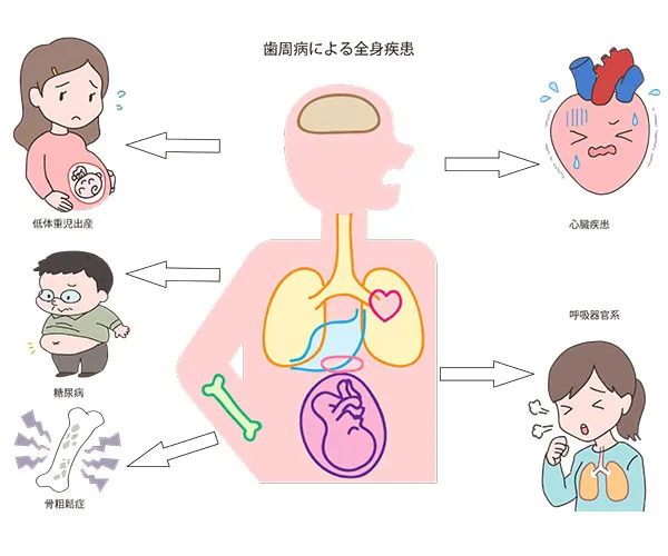 歯周病と全身疾患関係性