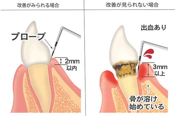 精密歯周病治療