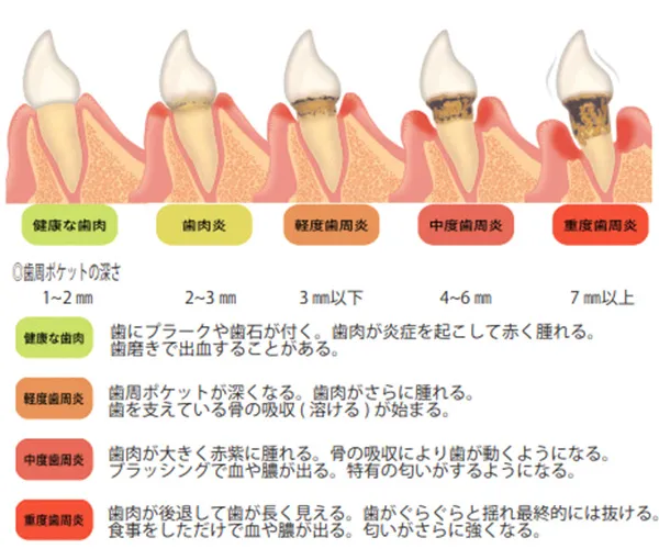 歯周病の進行状態