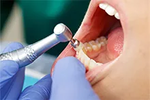 歯科衛生士処置