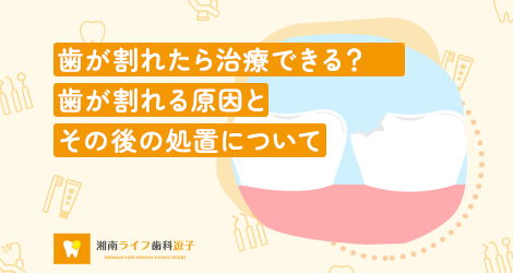 歯が割れたら治療できる？歯が割れる原因とその後の処置について